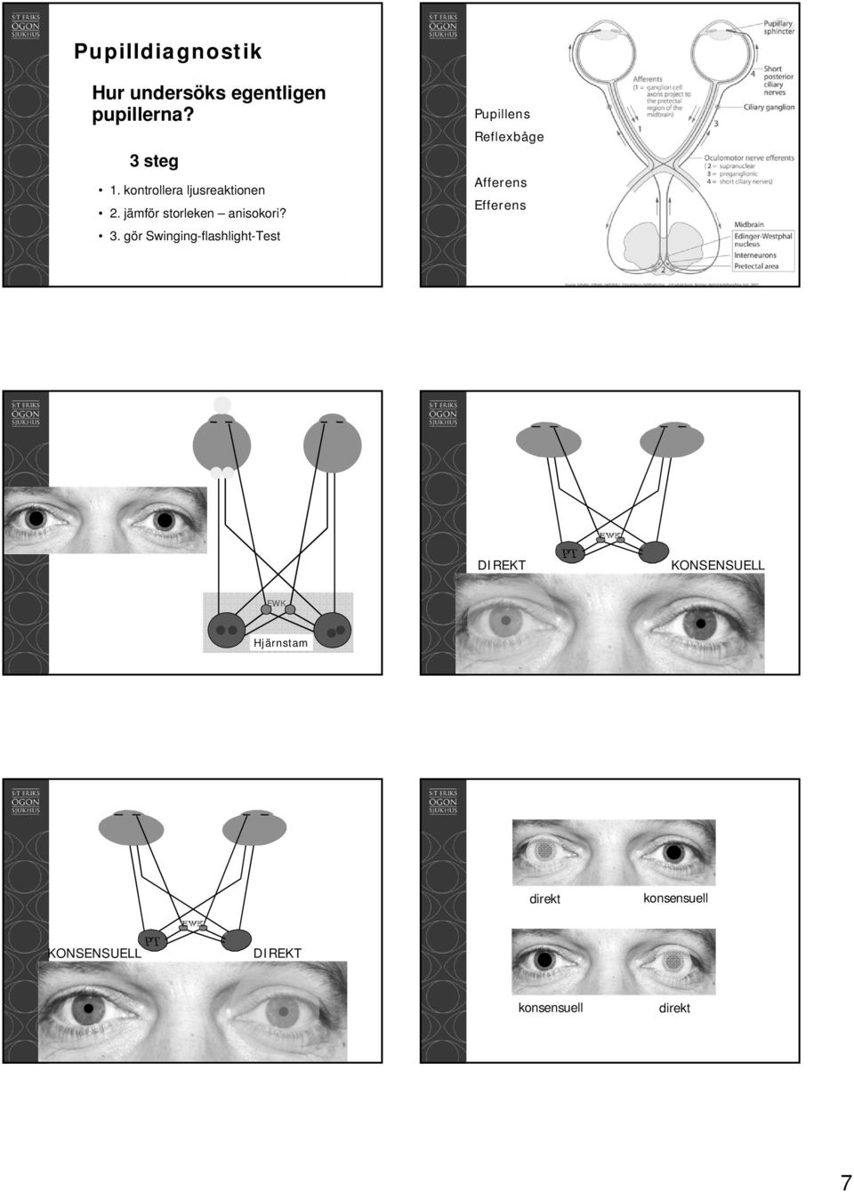 gör Swinging-flashlight-Test Pupillens Reflexbåge Afferens Efferens