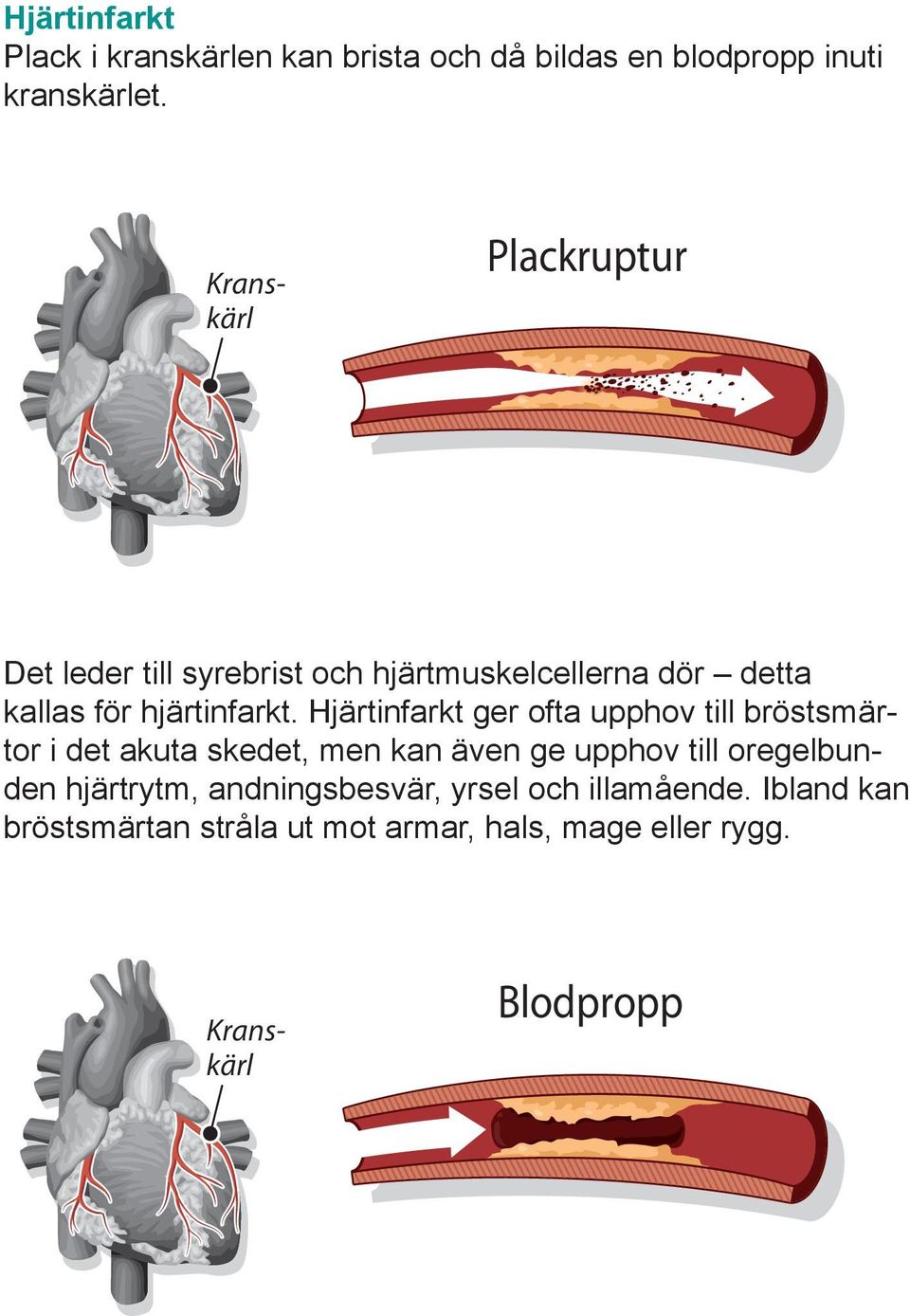 Hjärtinfarkt ger ofta upphov till bröstsmärtor i det akuta skedet, men kan även ge upphov till oregelbunden