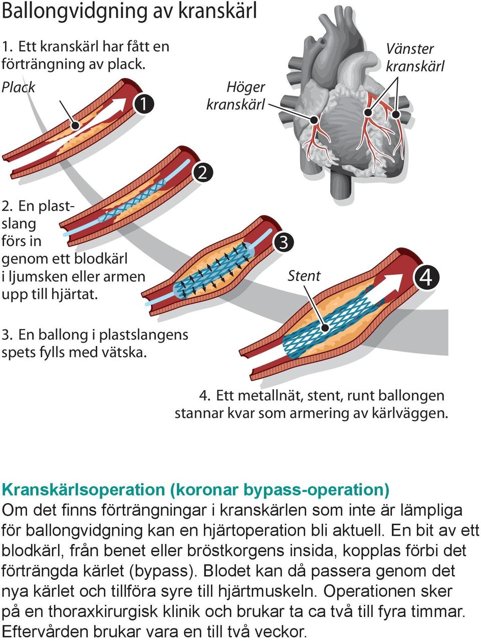 Kranskärlsoperation (koronar bypass-operation) Om det finns förträngningar i kranskärlen som inte är lämpliga för ballongvidgning kan en hjärtoperation bli aktuell.