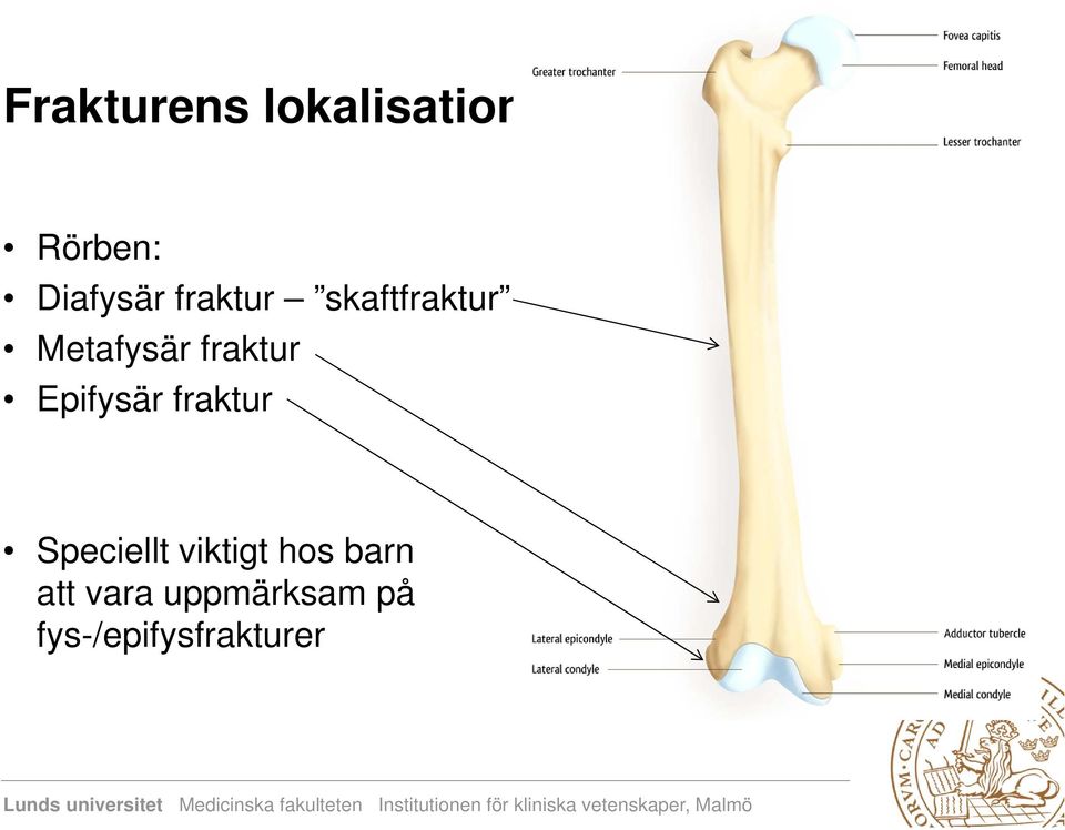 Epifysär fraktur Speciellt viktigt hos