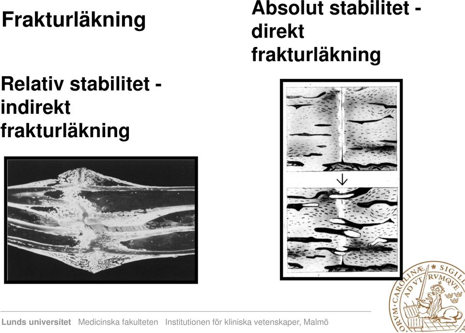 frakturläkning Absolut