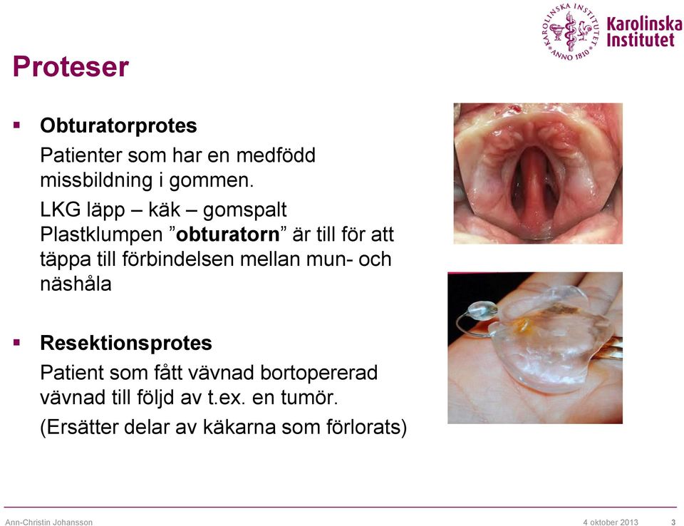 mellan mun- och näshåla Resektionsprotes Patient som fått vävnad bortopererad vävnad till