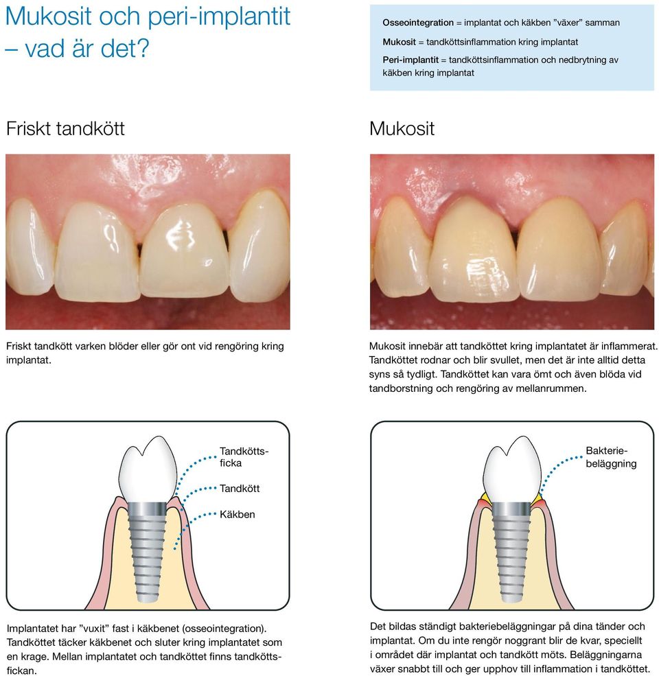 Mukosit Friskt tandkött varken blöder eller gör ont vid rengöring kring implantat. Mukosit innebär att tandköttet kring implantatet är inflammerat.