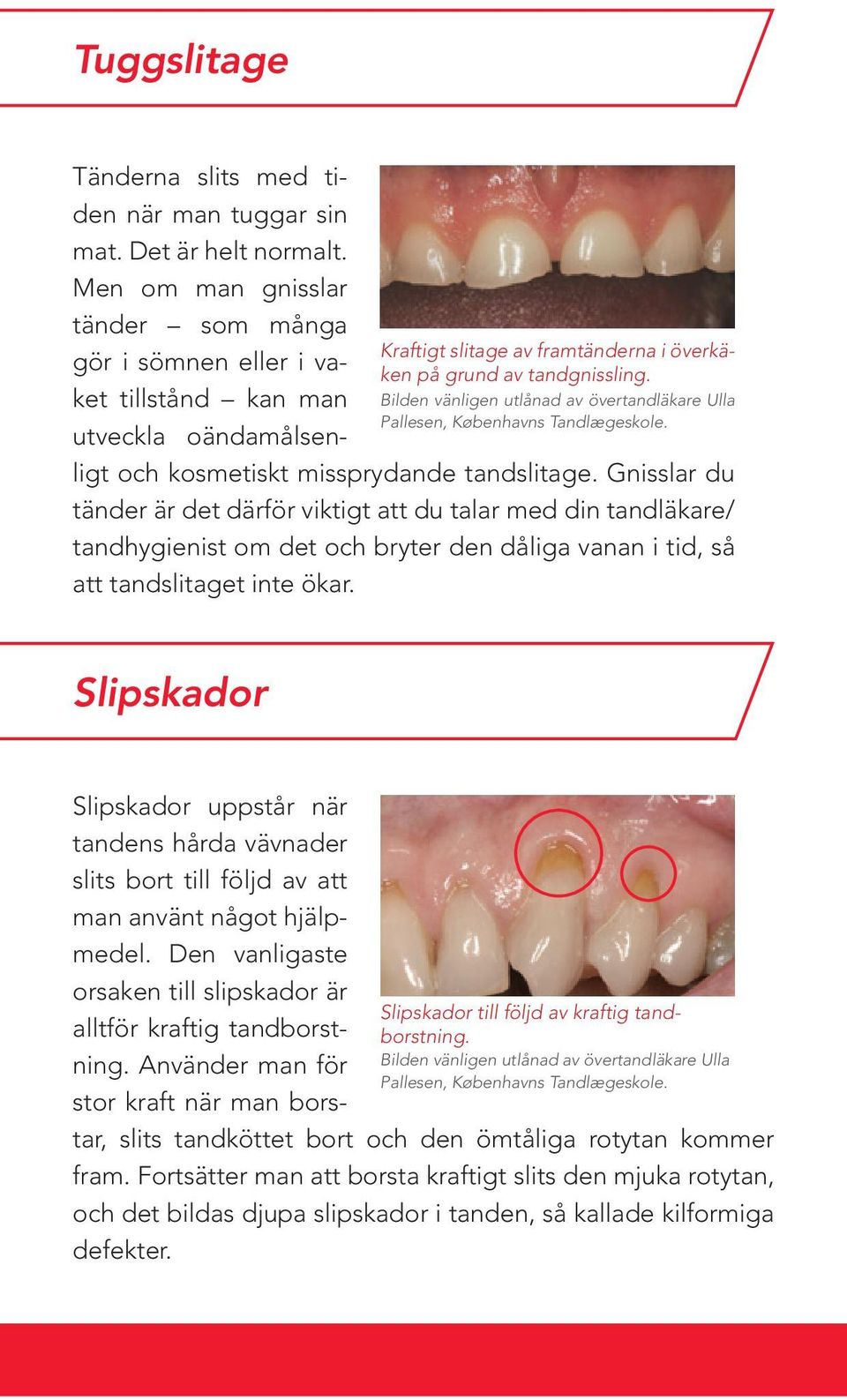 Men om man gnisslar tänder som många gör i sömnen eller i vaket tillstånd kan man utveckla oändamålsenligt och kosmetiskt missprydande tandslitage.