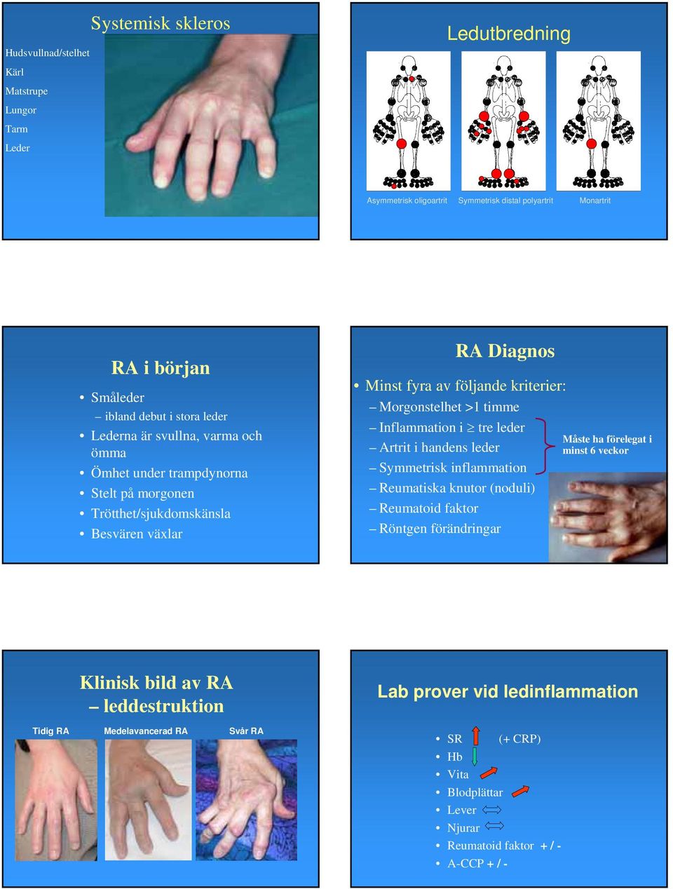 Morgonstelhet >1 timme Inflammation i tre leder Artrit i handens leder Symmetrisk inflammation Reumatiska knutor (noduli) Reumatoid faktor Röntgen förändringar Måste ha förelegat i