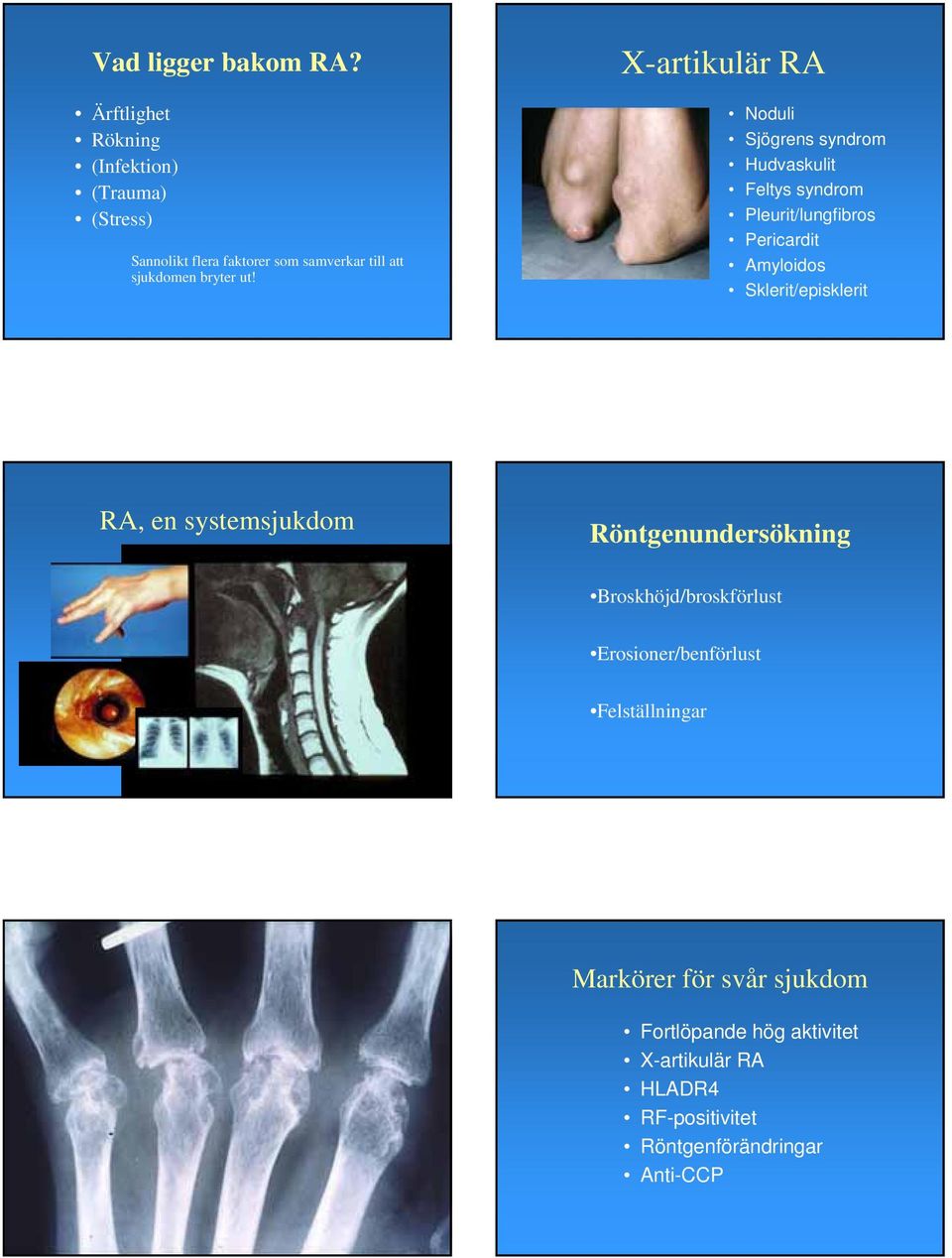 X-artikulär RA Noduli Sjögrens syndrom Hudvaskulit Feltys syndrom Pleurit/lungfibros Pericardit Amyloidos