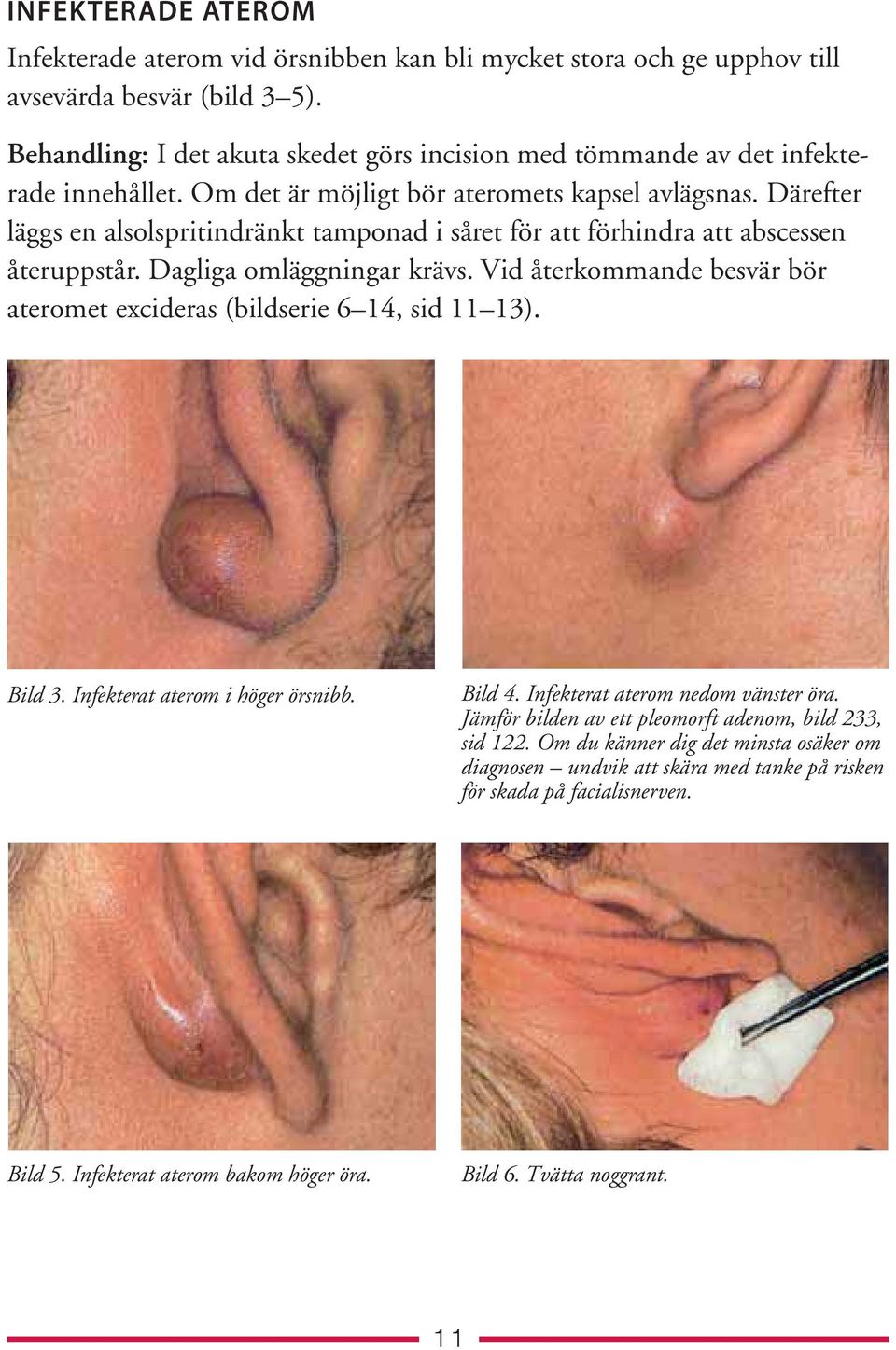 Därefter läggs en alsolspritindränkt tamponad i såret för att förhindra att abscessen återuppstår. Dagliga omläggningar krävs.