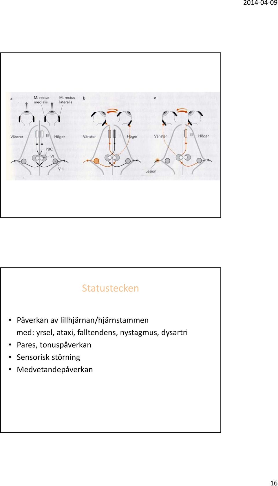 ataxi, falltendens, nystagmus, dysartri