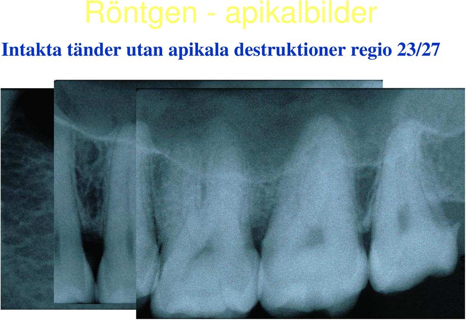 Intakta tänder