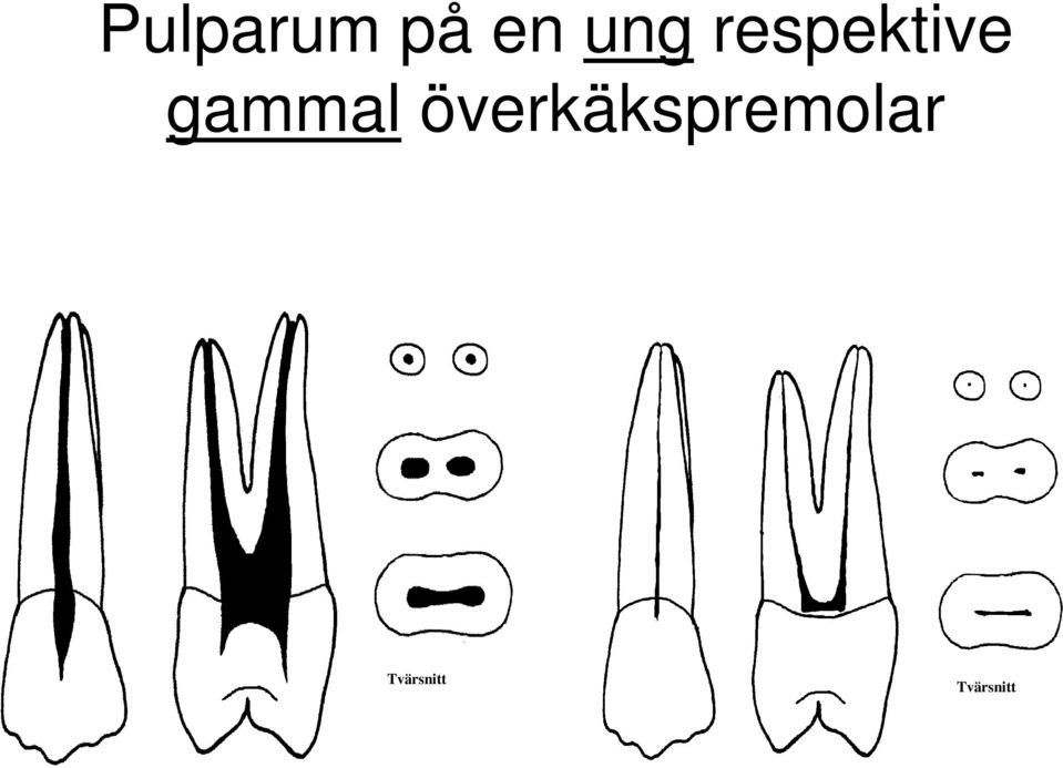 överkäkspremolar