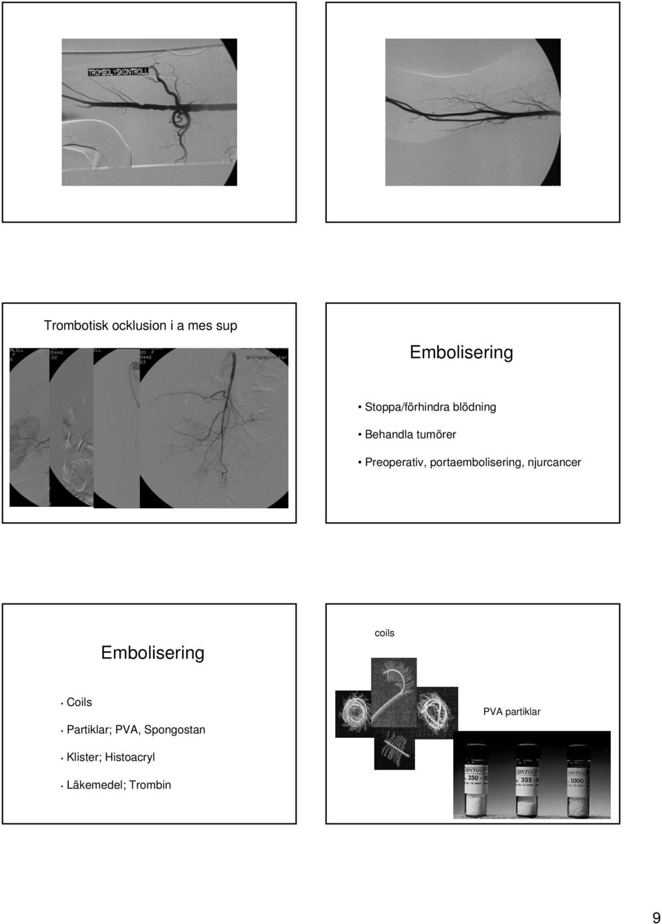 portaembolisering, njurcancer Embolisering coils Coils