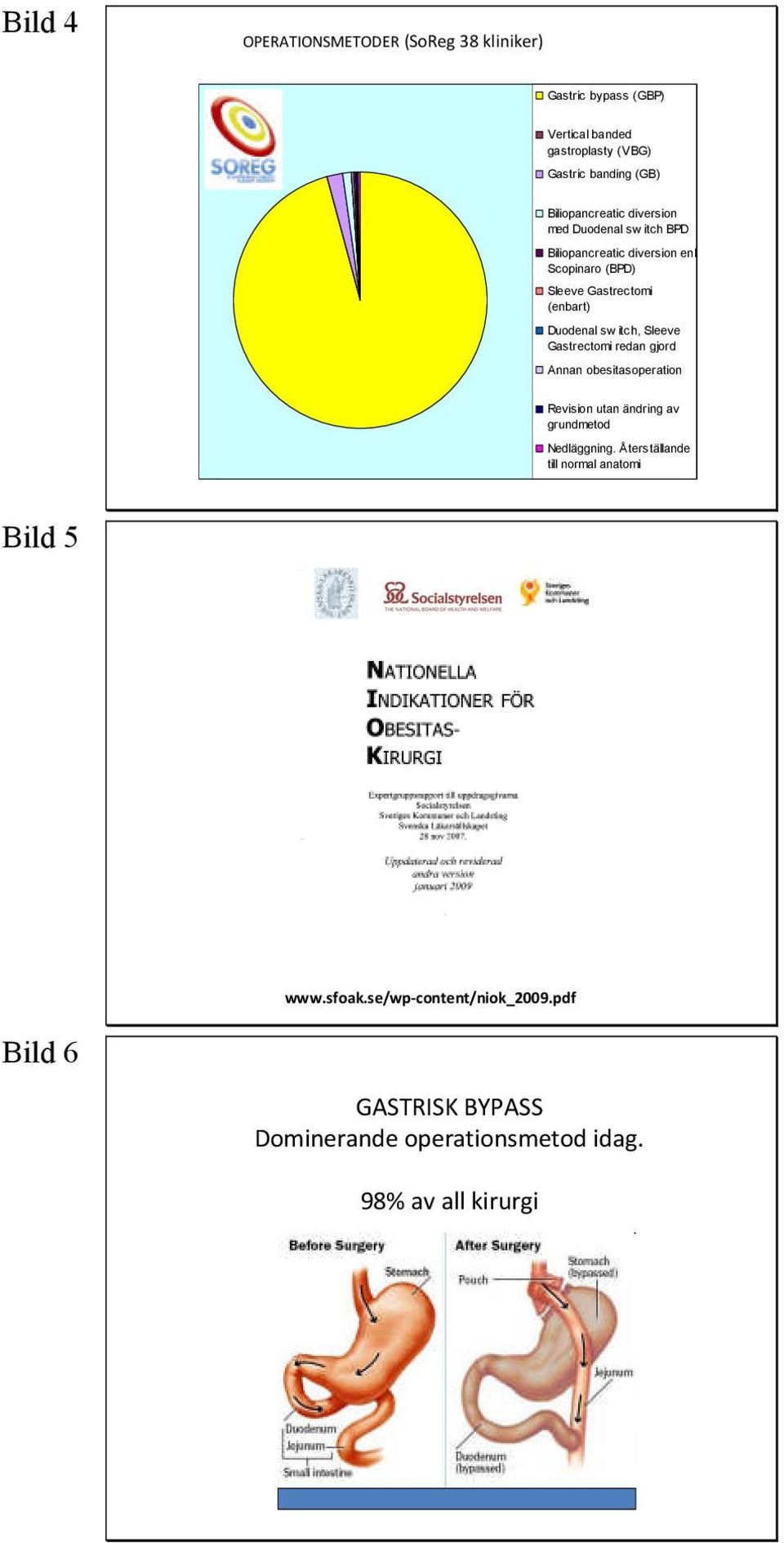 Duodenal sw itch, Sleeve Gastrectomi redan gjord Annan obesitasoperation Revision utan ändring av grundmetod Nedläggning.