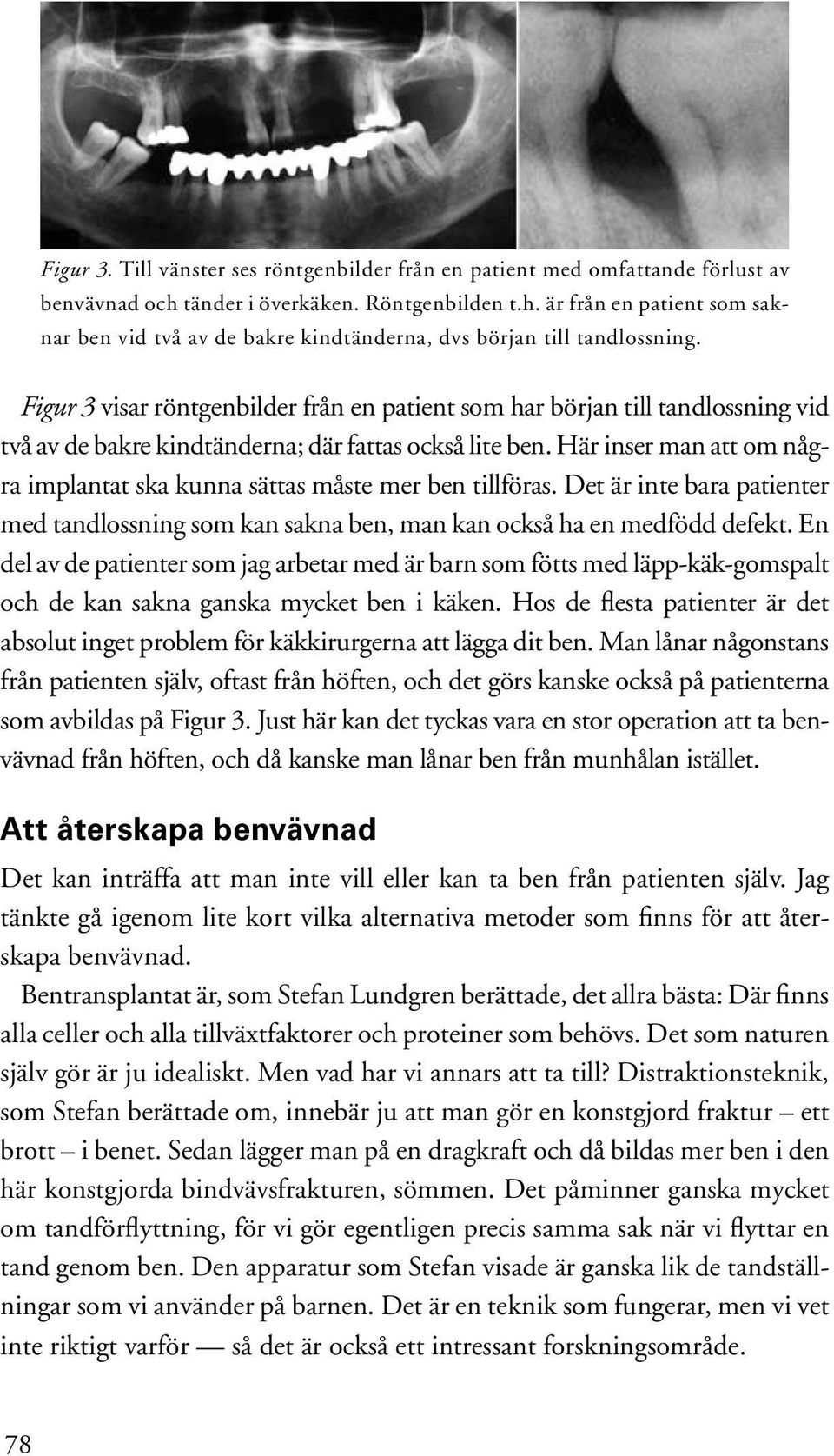 Här inser man att om några implantat ska kunna sättas måste mer ben tillföras. Det är inte bara patienter med tandlossning som kan sakna ben, man kan också ha en medfödd defekt.