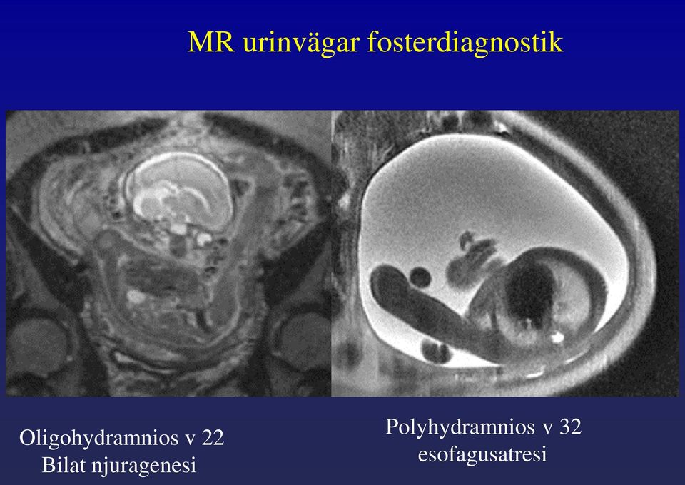 Oligohydramnios v 22