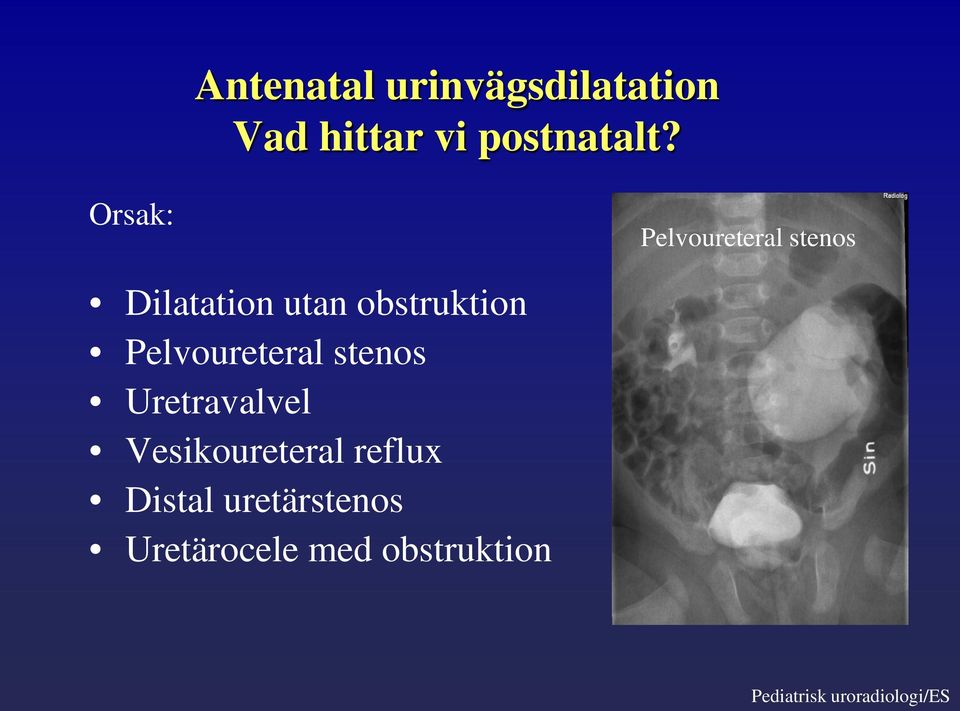 Pelvoureteral stenos Uretravalvel Vesikoureteral reflux