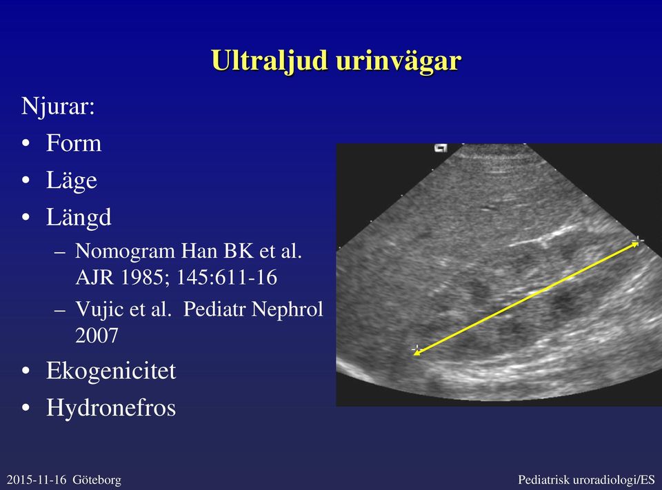 Pediatr Nephrol 2007 Ekogenicitet Hydronefros