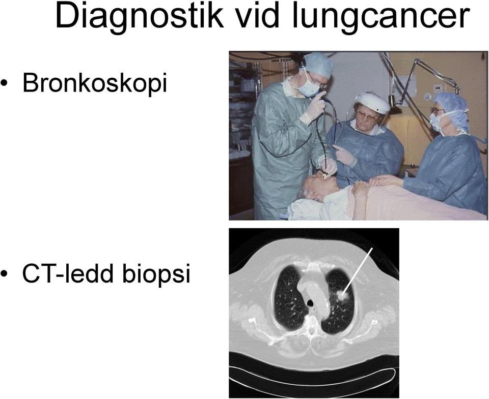 lungcancer