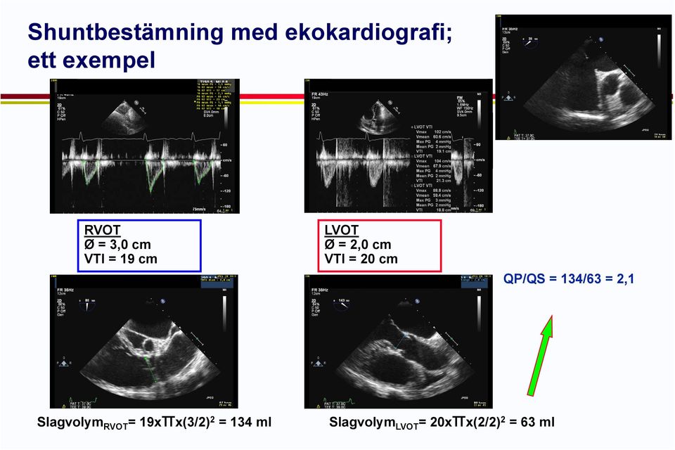 20 cm QP/QS = 134/63 = 21 2,1 Slagvolym RVOT =