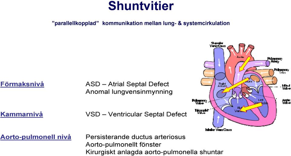 lungvensinmynning Kammarnivå VSD Ventricular Septal Defect Aorto-pulmonell