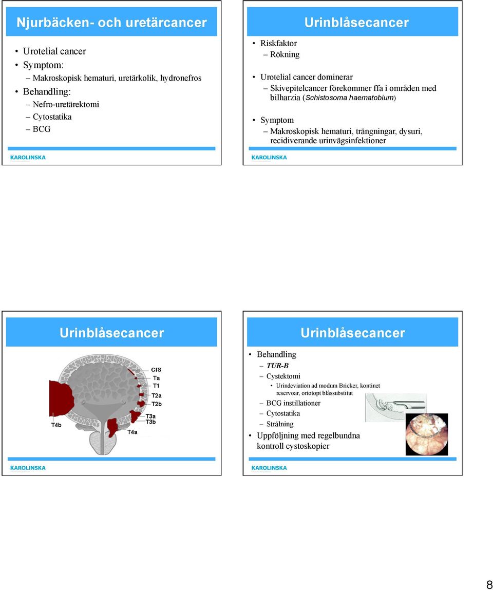 Makroskopisk hematuri, trängningar, dysuri, recidiverande urinvägsinfektioner Urinblåsecancer Urinblåsecancer Behandling TUR-B Cystektomi Urindeviation