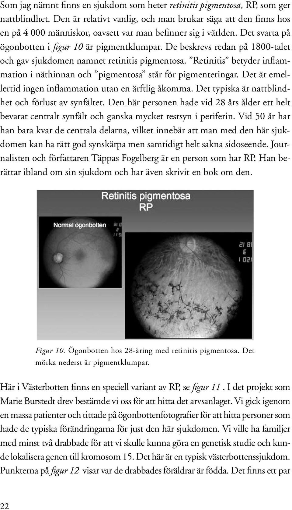 De beskrevs redan på 1800-talet och gav sjukdomen namnet retinitis pigmentosa. Retinitis betyder inflammation i näthinnan och pigmentosa står för pigmenteringar.