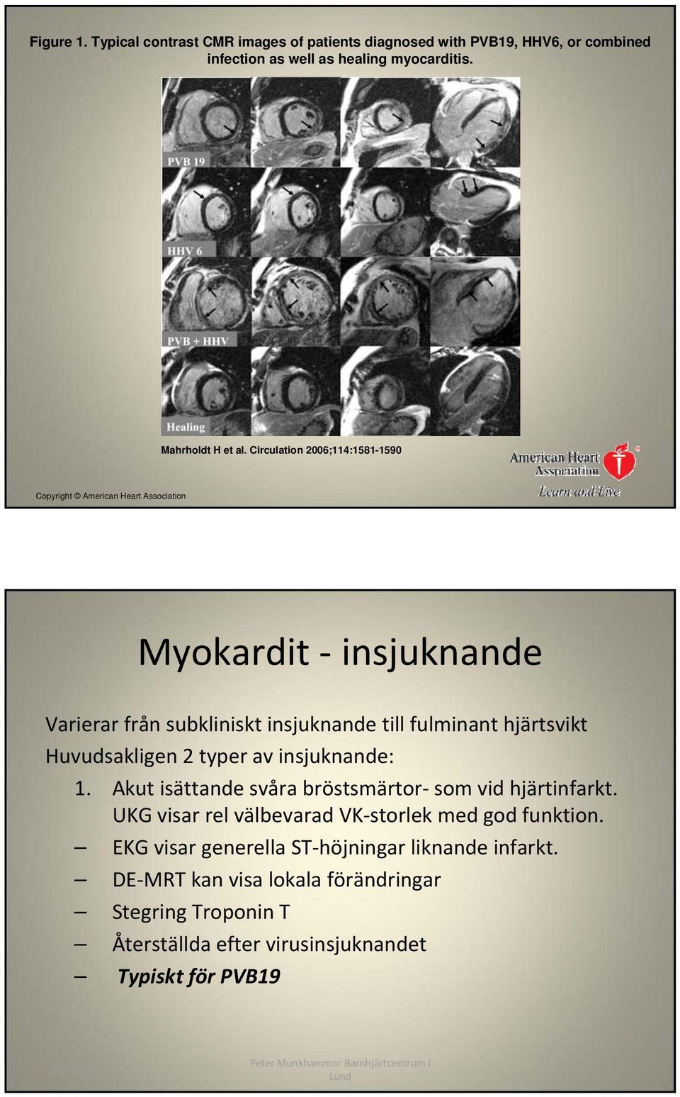 Huvudsakligen 2 typer av insjuknande: 1. Akut isättande svåra bröstsmärtor som vid hjärtinfarkt. UKG visar rel välbevarad VK storlek med god funktion.