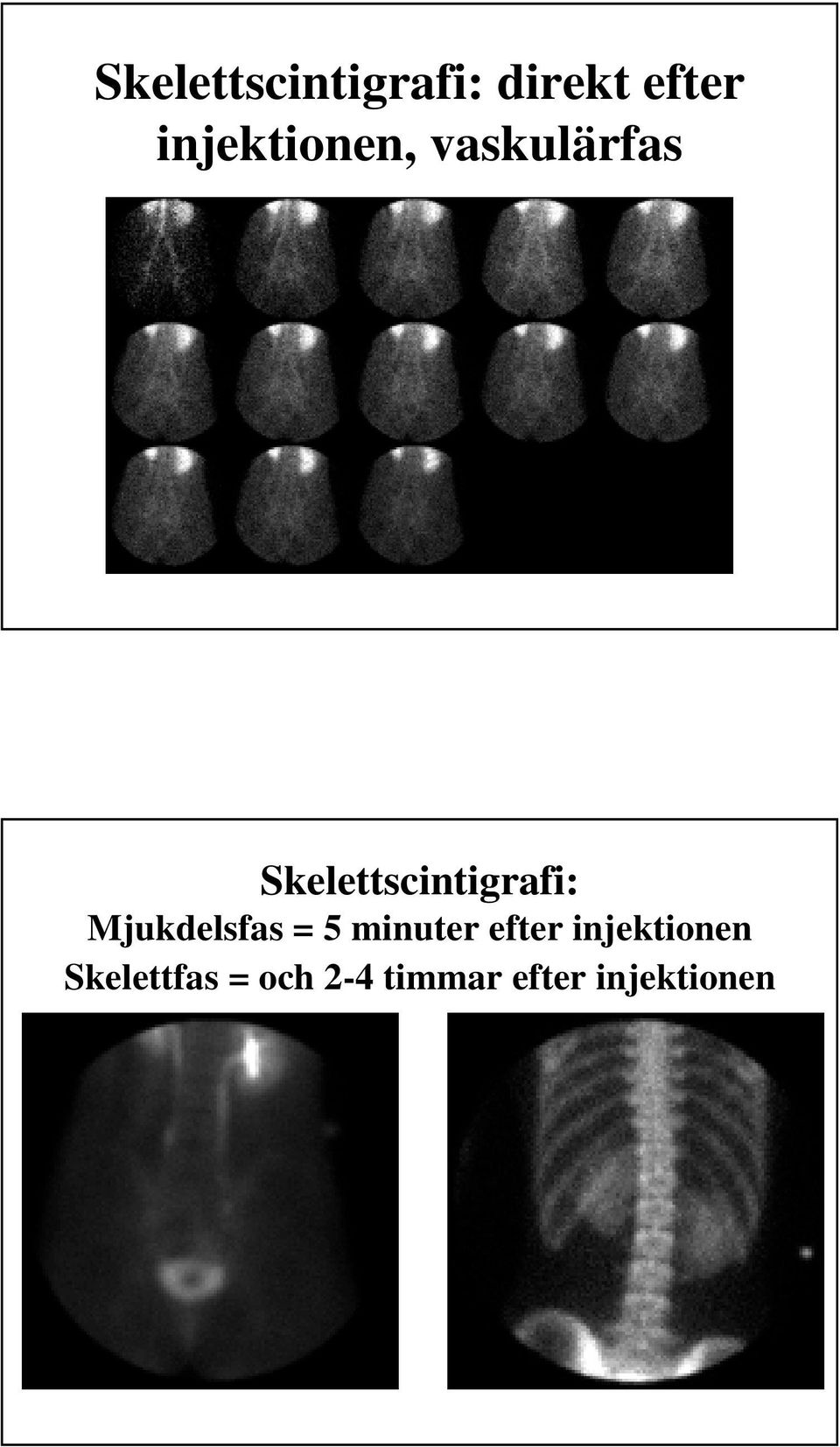 Skelettscintigrafi: Mjukdelsfas = 5