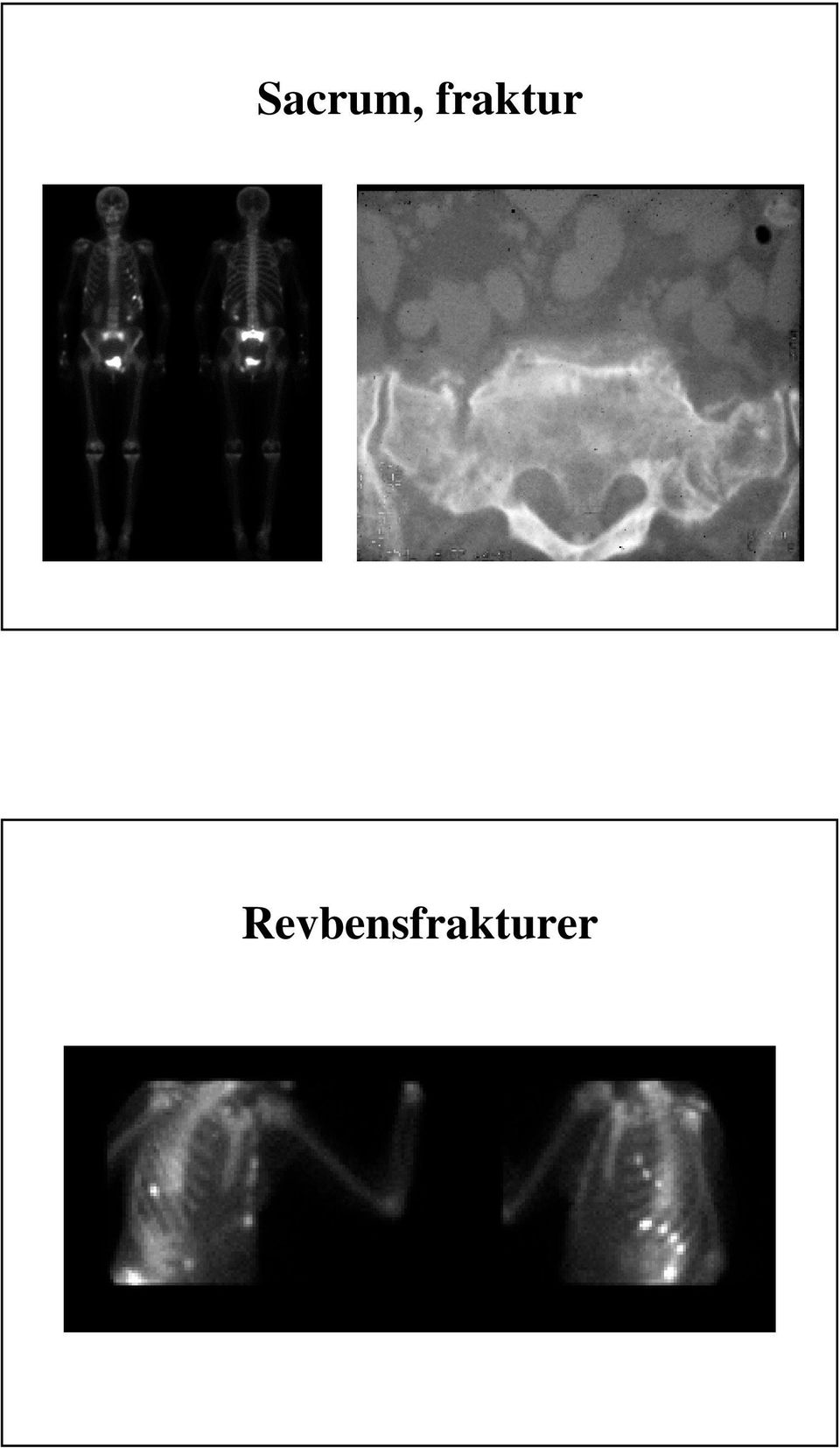 Revbenser