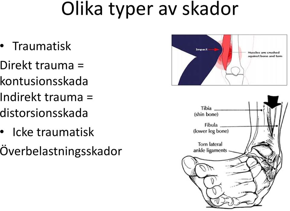 Indirekt trauma = distorsionsskada