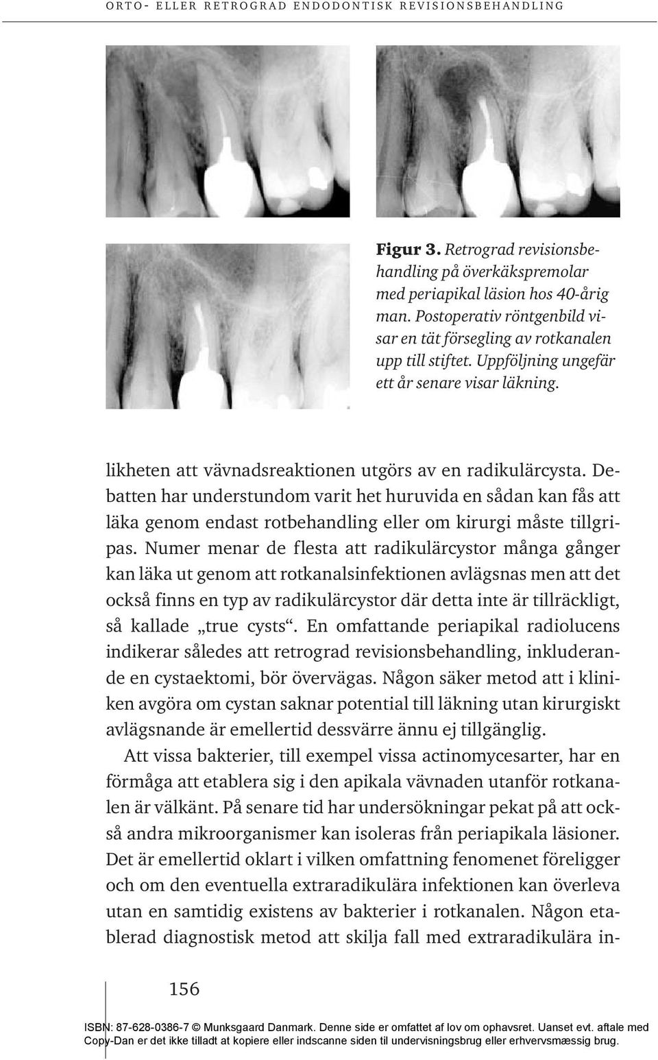 Debatten har understundom varit het huruvida en sådan kan fås att läka genom endast rotbehandling eller om kirurgi måste tillgripas.