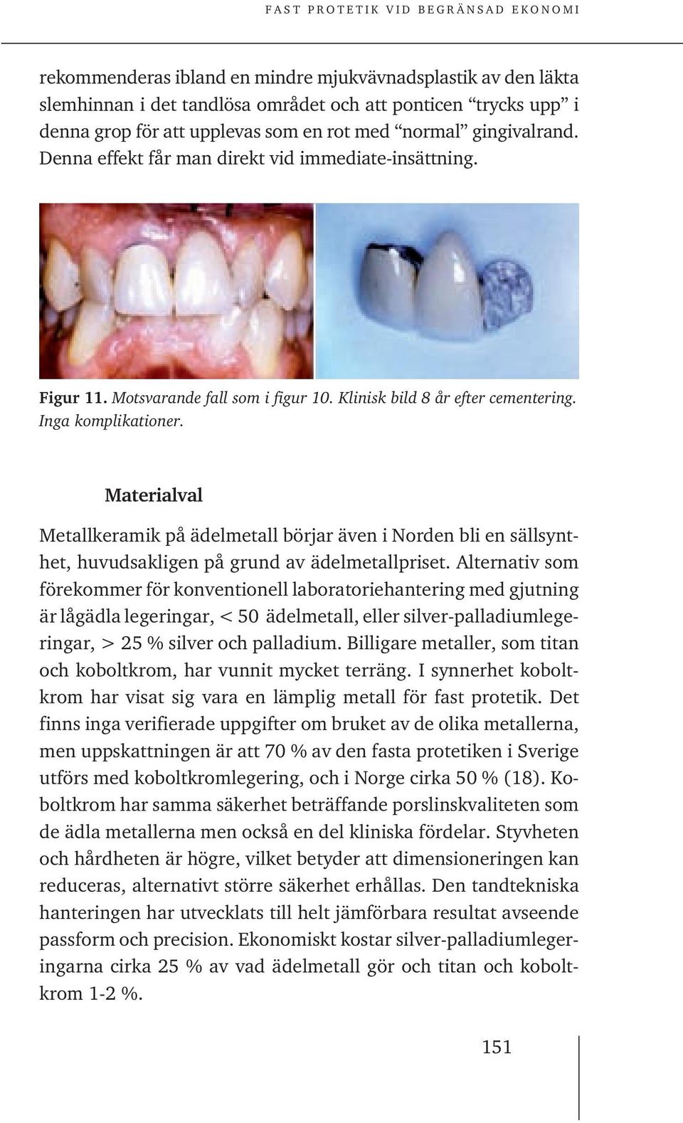 Materialval Metallkeramik på ädelmetall börjar även i Norden bli en sällsynthet, huvudsakligen på grund av ädelmetallpriset.