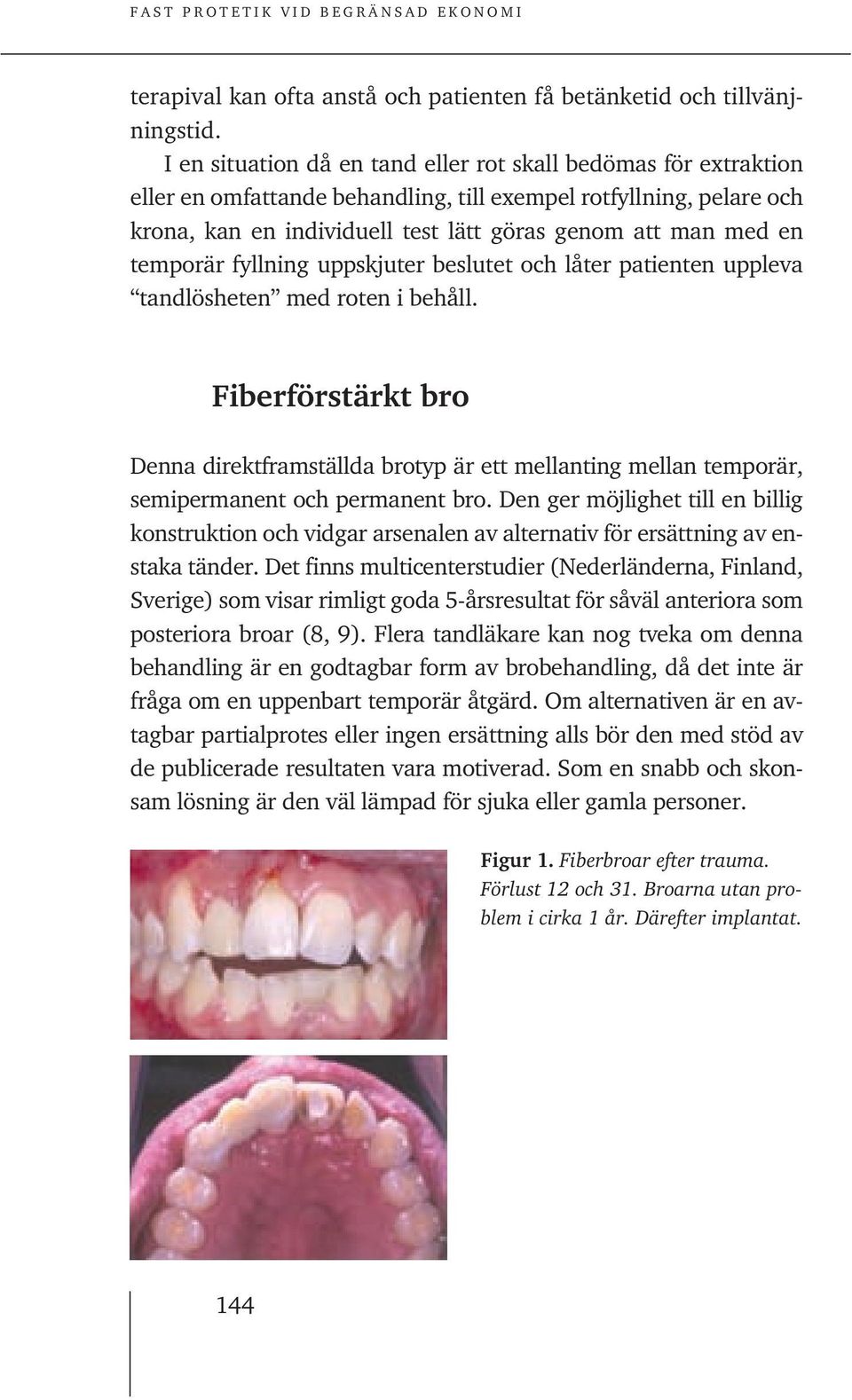 temporär fyllning uppskjuter beslutet och låter patienten uppleva tandlösheten med roten i behåll.