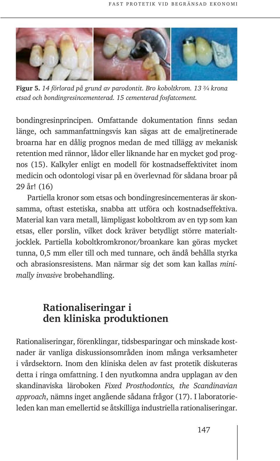 liknande har en mycket god prognos (15). Kalkyler enligt en modell för kostnadseffektivitet inom medicin och odontologi visar på en överlevnad för sådana broar på 29 år!