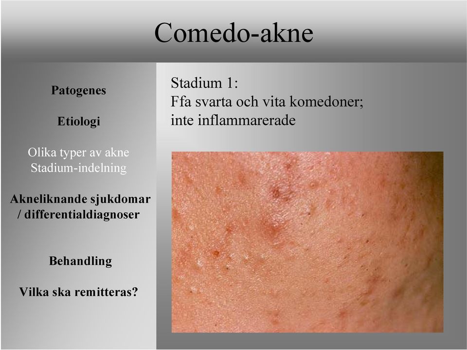 komedoner; inte