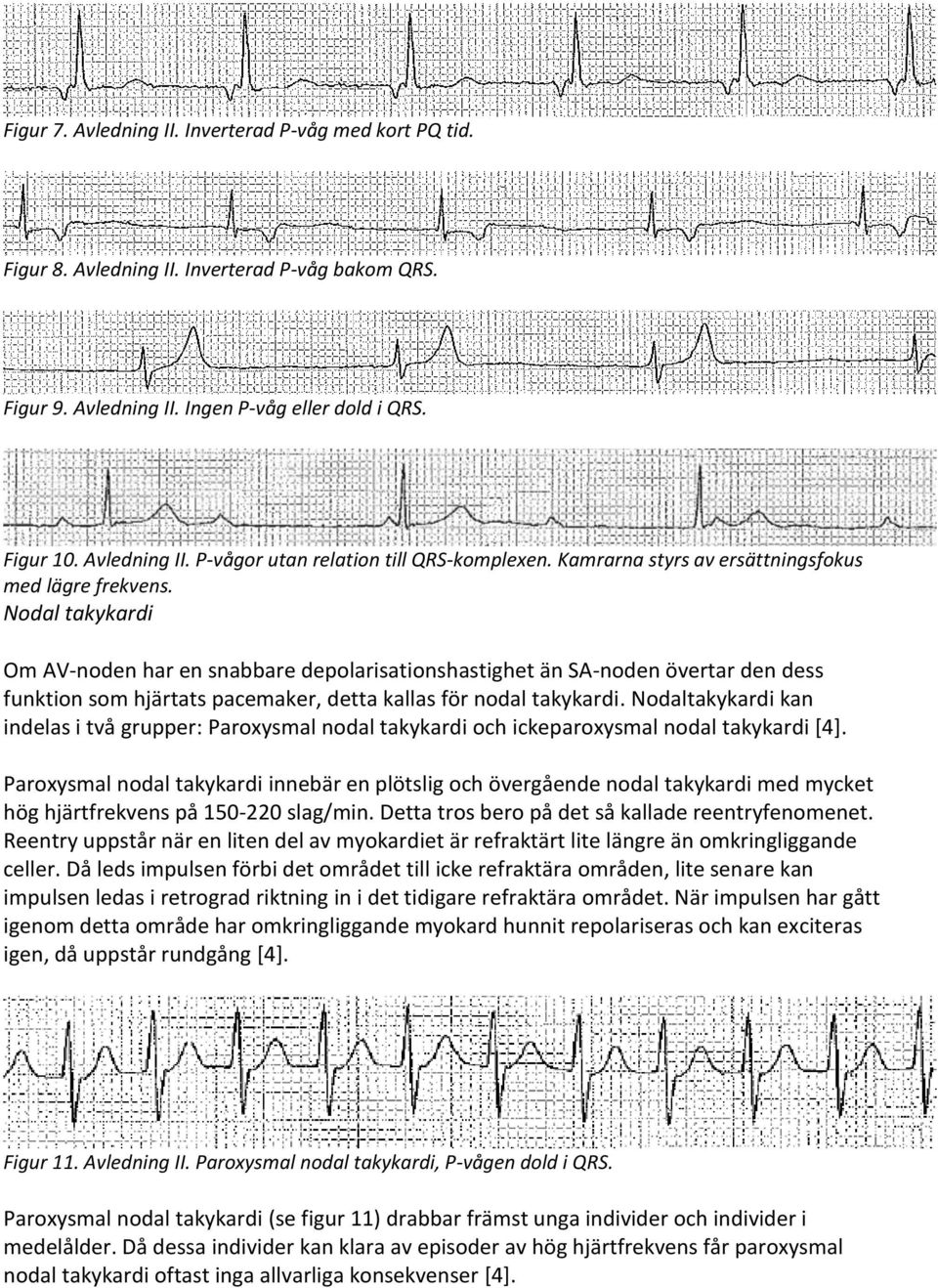 Nodal takykardi Om AV-noden har en snabbare depolarisationshastighet än SA-noden övertar den dess funktion som hjärtats pacemaker, detta kallas för nodal takykardi.