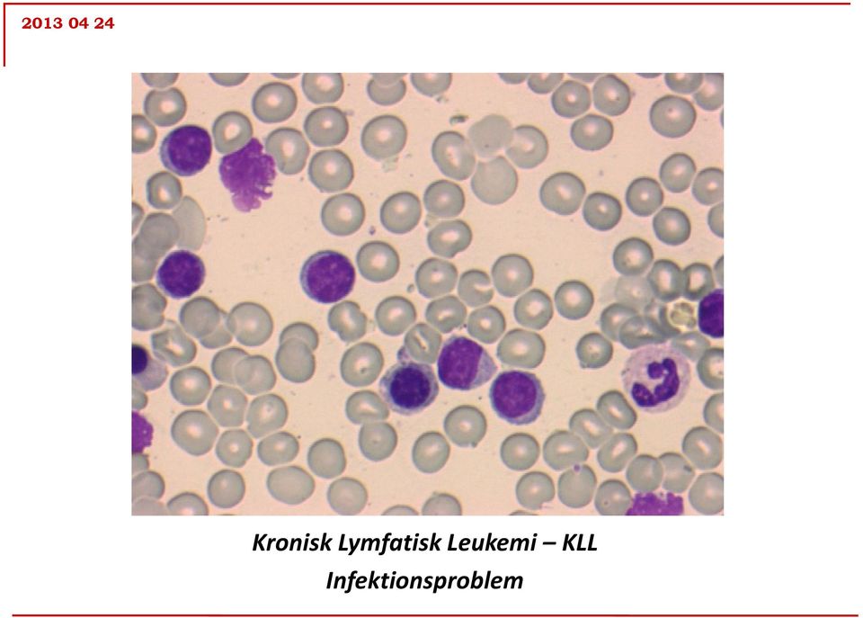 Leukemi KLL