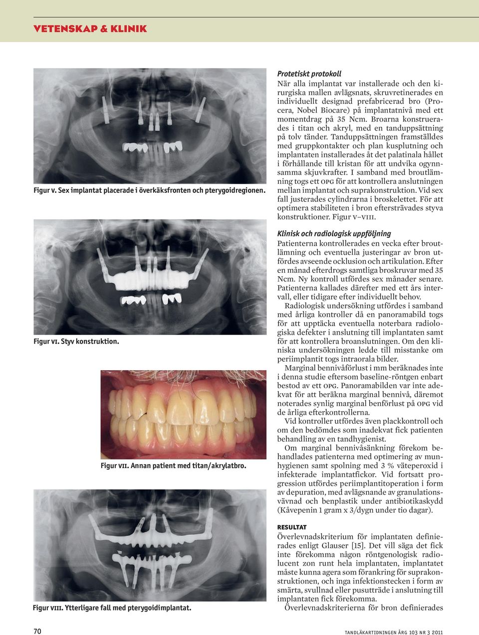 Protetiskt protokoll När alla implantat var installerade och den kirurgiska mallen avlägsnats, skruvretinerades en individuellt designad prefabricerad bro (Procera, Nobel Biocare) på implantatnivå