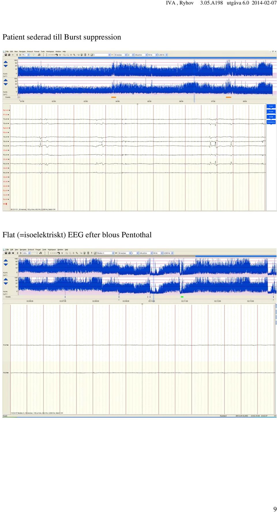 Flat (=isoelektriskt)