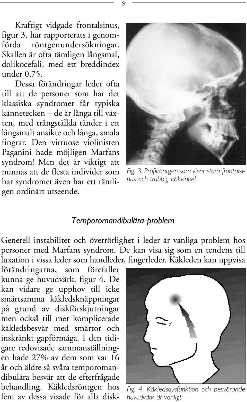 fingrar. Den virtuose violinisten Paganini hade möjligen Marfans syndrom! Men det är viktigt att minnas att de flesta individer som har syndromet även har ett tämligen ordinärt utseende. Fig. 3.