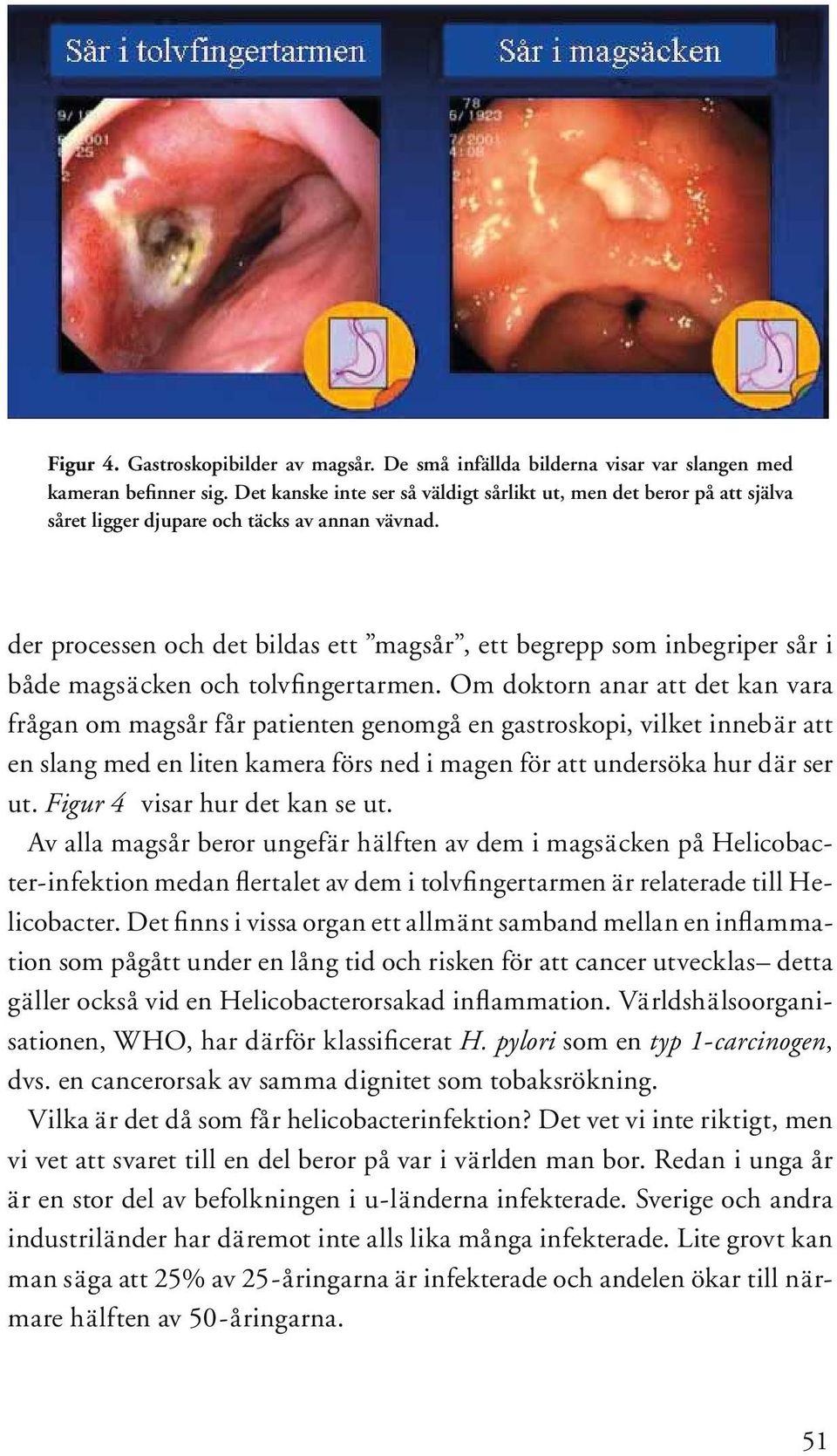 der processen och det bildas ett magsår, ett begrepp som inbegriper sår i både magsäcken och tolvfingertarmen.