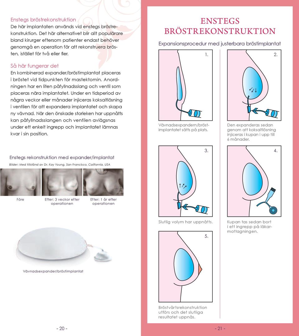 ENSTEGS BRÖSTREKONSTRUKTION Expansionsprocedur med justerbara bröstimplantat 1. 2. Så här fungerar det En kombinerad expander/bröstimplantat placeras i bröstet vid tidpunkten för mastektomin.