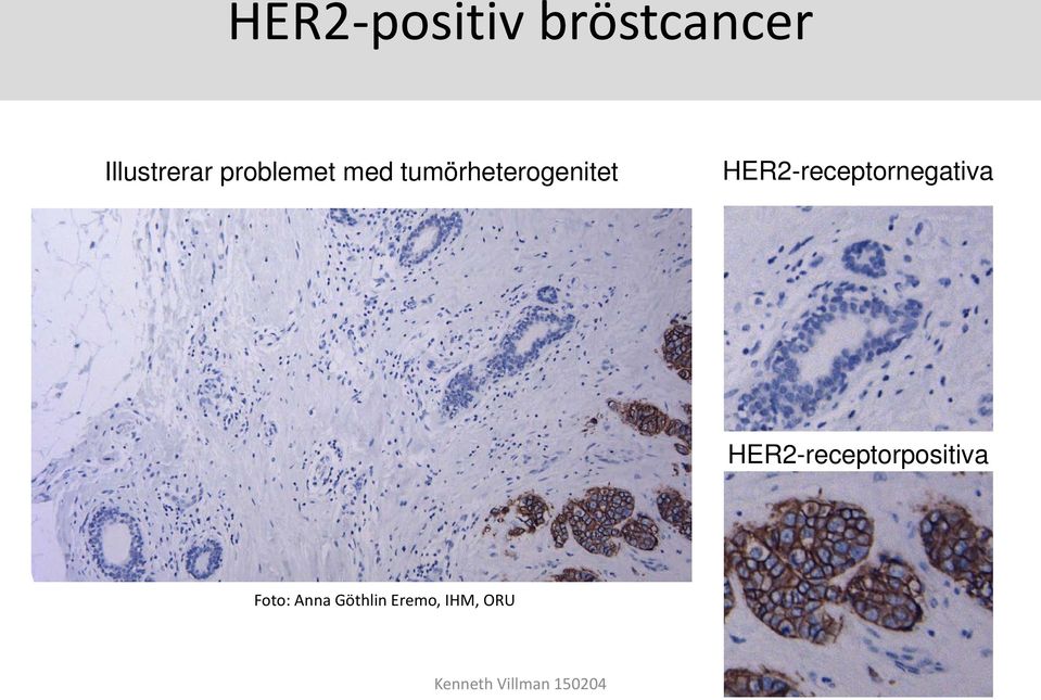 HER2-receptornegativa HER2-receptorpositiva