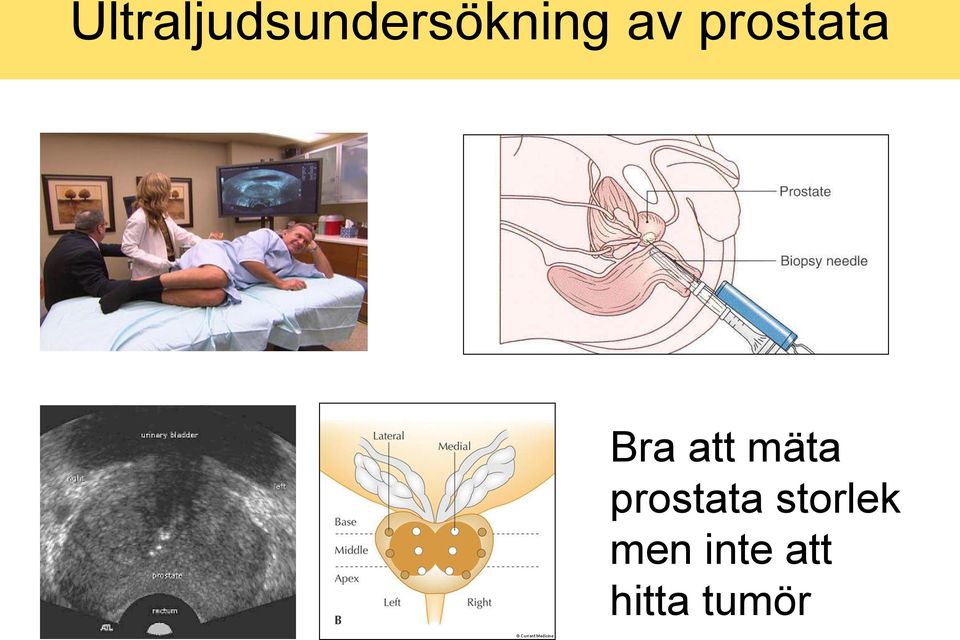 mäta prostata storlek
