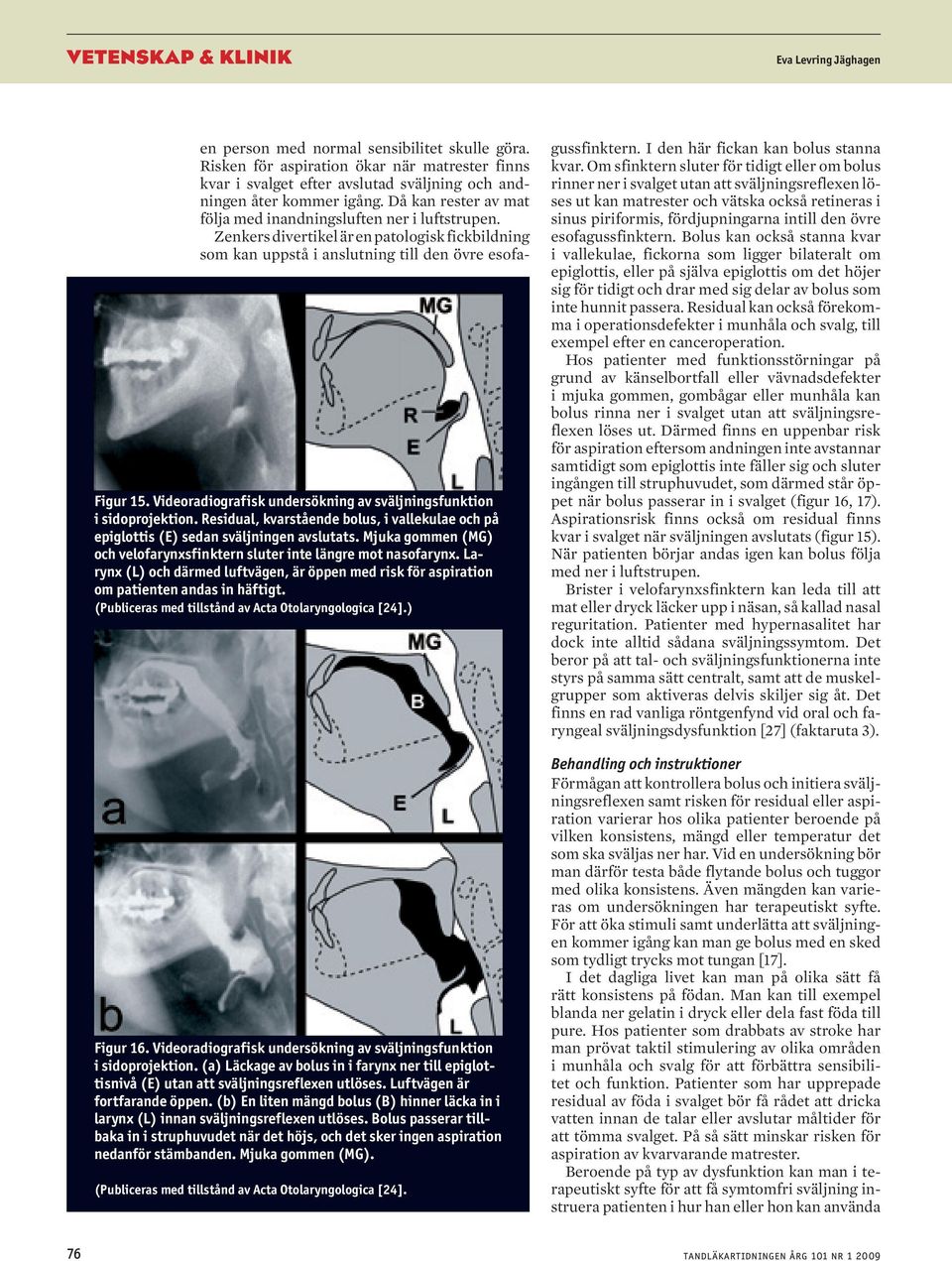 Videordiogrfisk undersökning v sväljningsfunktion i sidoprojektion. Residul, kvrstående olus, i vllekule och på epiglottis (E) sedn sväljningen vslutts.
