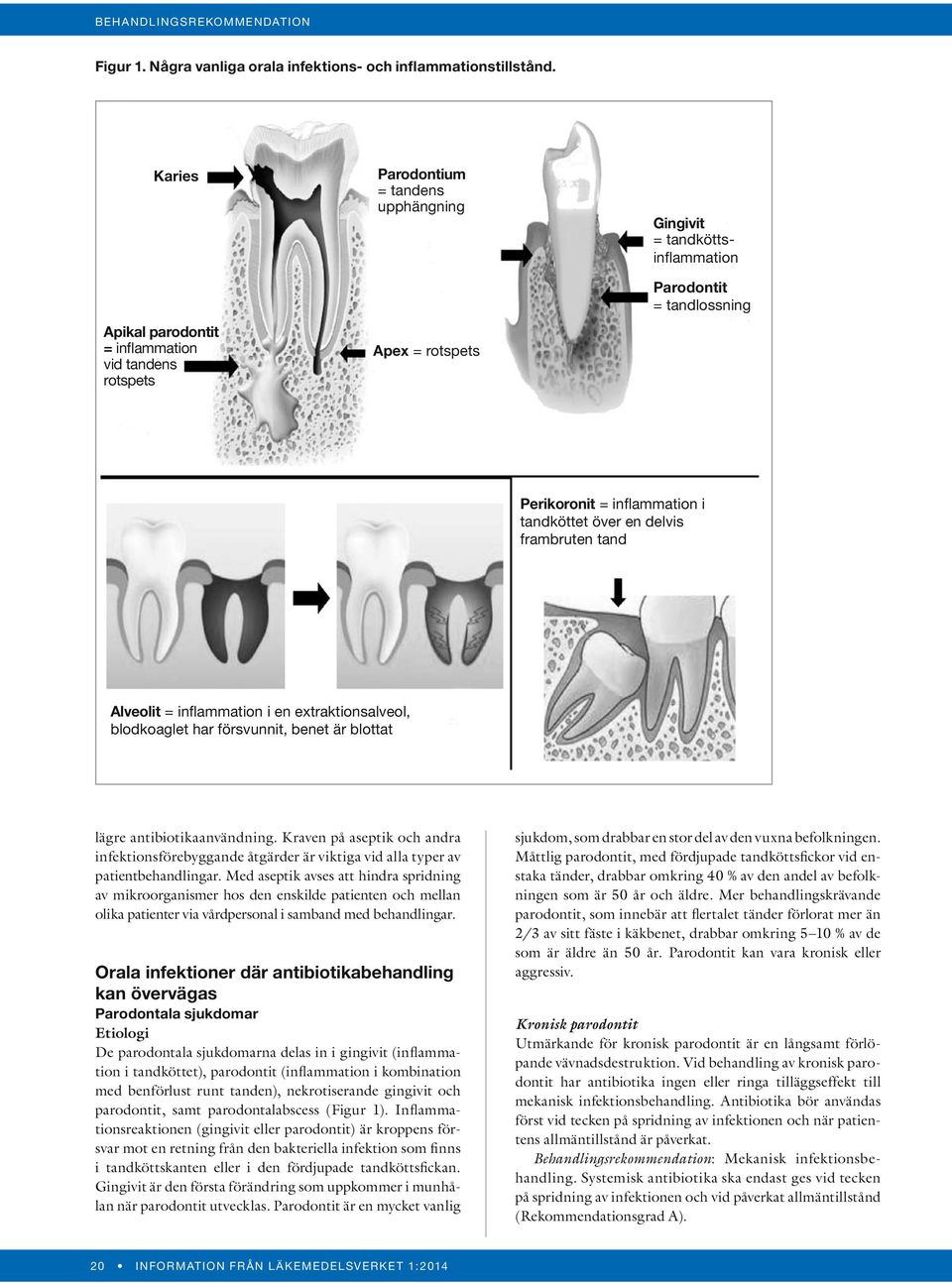 tandköttet över en delvis frambruten tand Alveolit = inflammation i en extraktionsalveol, blodkoaglet har försvunnit, benet är blottat lägre antibiotikaanvändning.