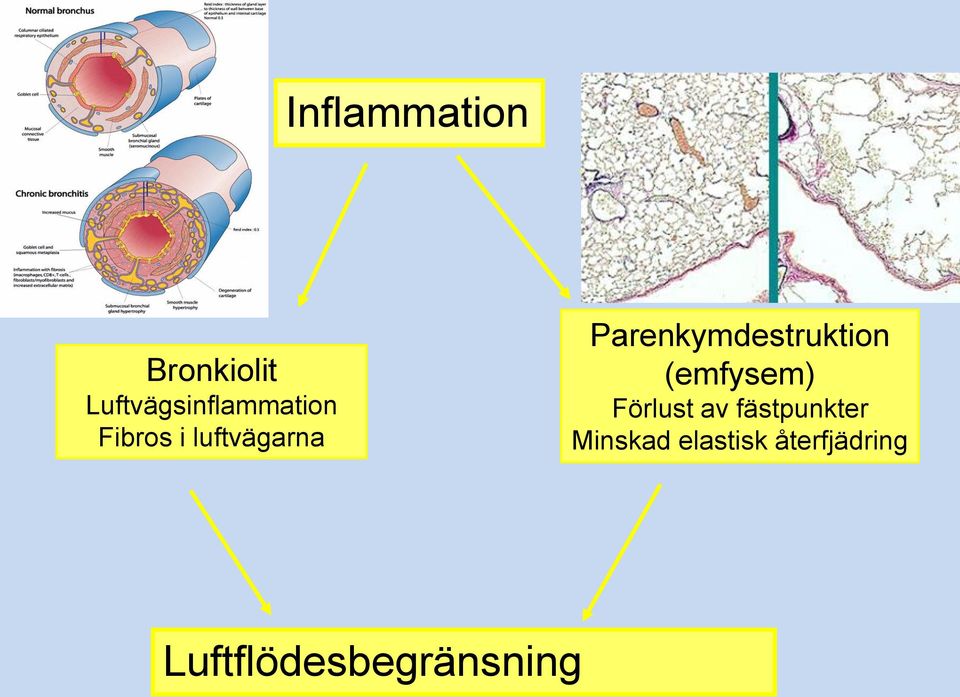 Parenkymdestruktion (emfysem) Förlust av