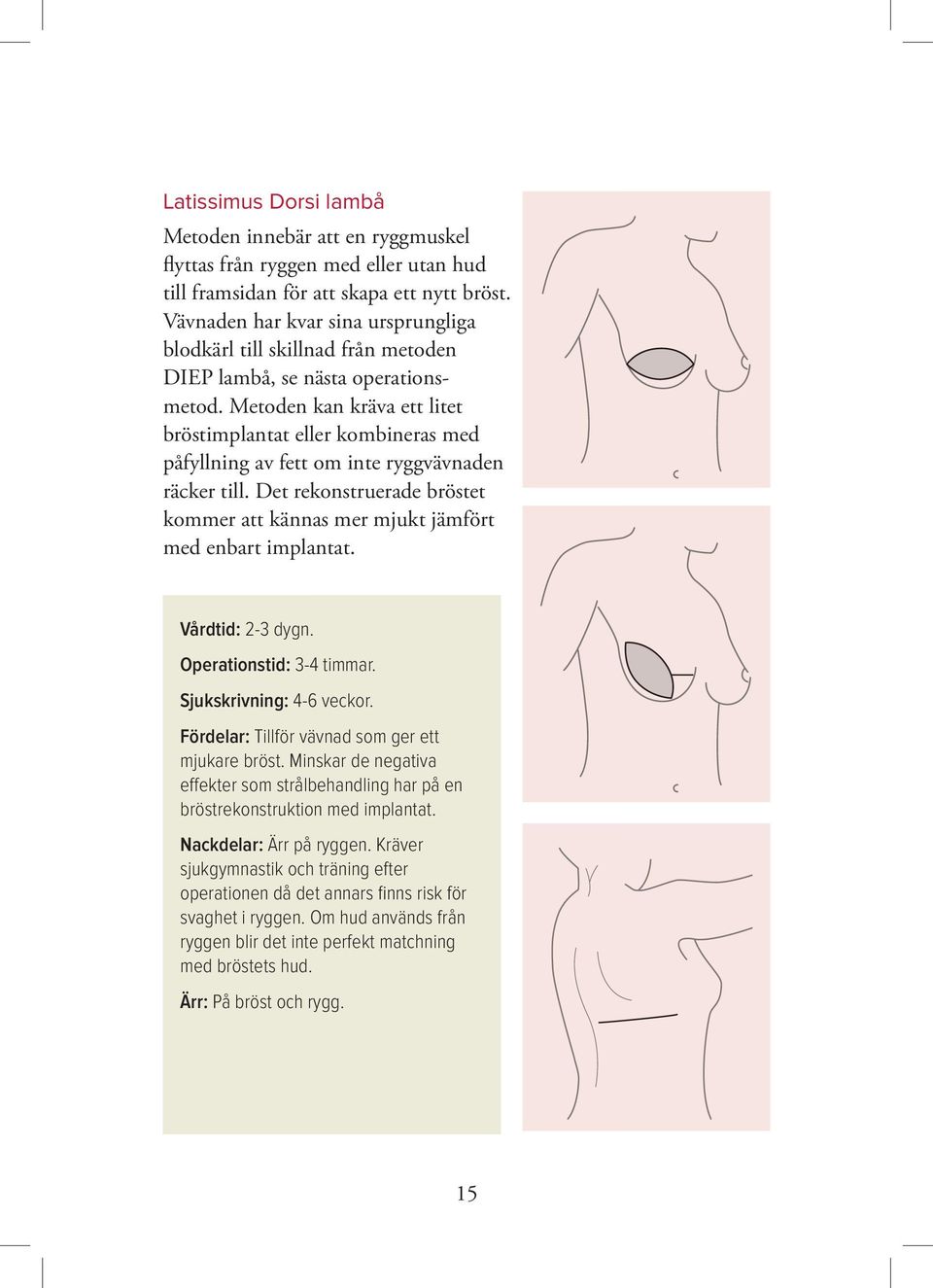 Metoden kan kräva ett litet bröstimplantat eller kombineras med påfyllning av fett om inte ryggvävnaden räcker till.