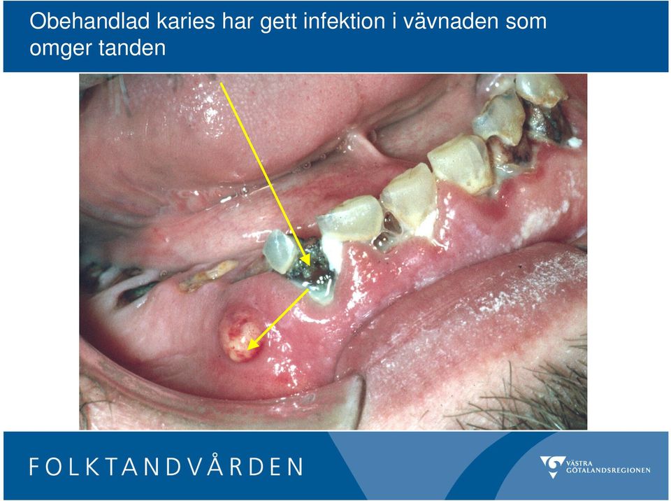 infektion i