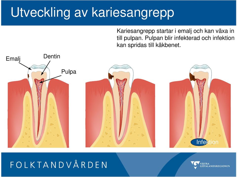 Pulpan blir infekterad och infektion kan