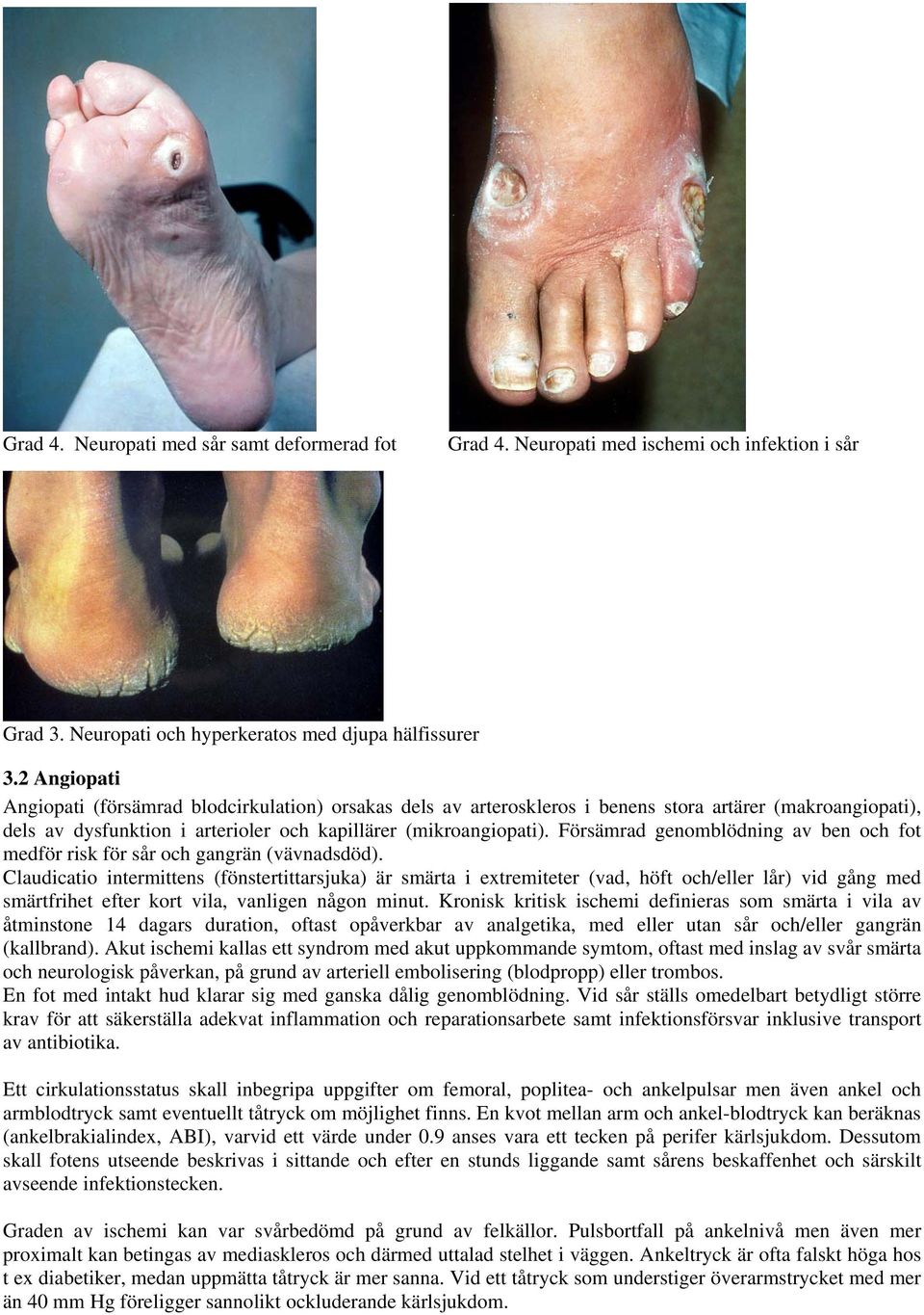 Försämrad genomblödning av ben och fot medför risk för sår och gangrän (vävnadsdöd).